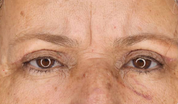 البليفاروبلاستي 1